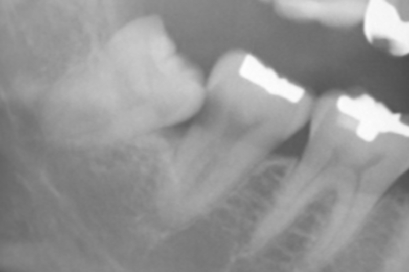 親知らずが原因で手前の歯のむし歯ができてしまい，両方とも保存が不可能となる可能性もあります．