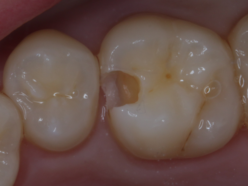 むし歯を撮り切った状態