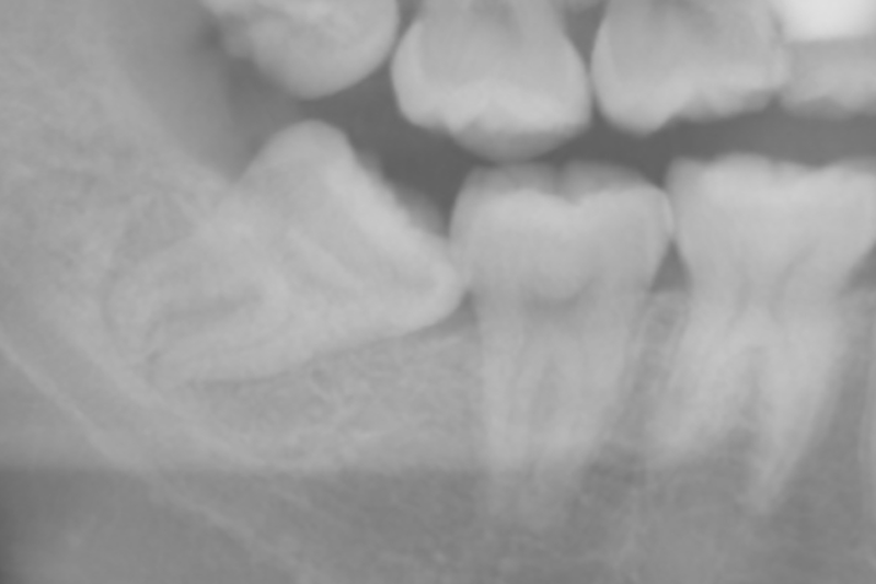 埋伏していて汚れの溜まりやすい状態の親知らずは手前の歯のむし歯や歯周病のリスクになります．