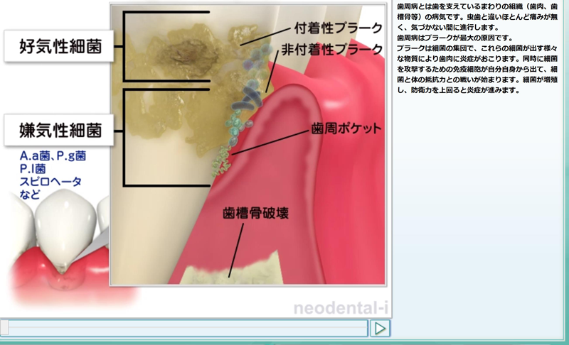 アニメーションを用いて治療の流れや期間についてわかりやすく説明します．