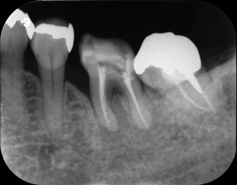 根管充填直後．まだ骨は戻ってきていないため，根の先は黒いままです．