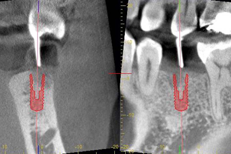 CT撮影を行いインプラントを埋める位置のシュミレーションを行っています