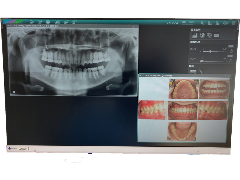 診療台の前に設置されたモニターで撮影した画像を瞬時に写し出しご説明いたします．