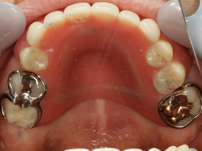 保険のレジン床の入れ歯です．強度を保つために厚みが必要なので，異物感は大きいです．