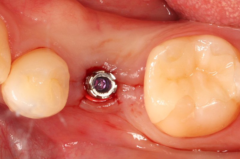 2次手術を行い口腔内にインプラントを露出させたところです．