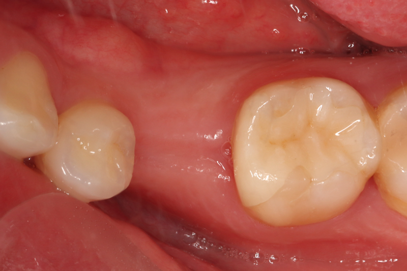 2次手術前の粘膜が治癒している状態です．