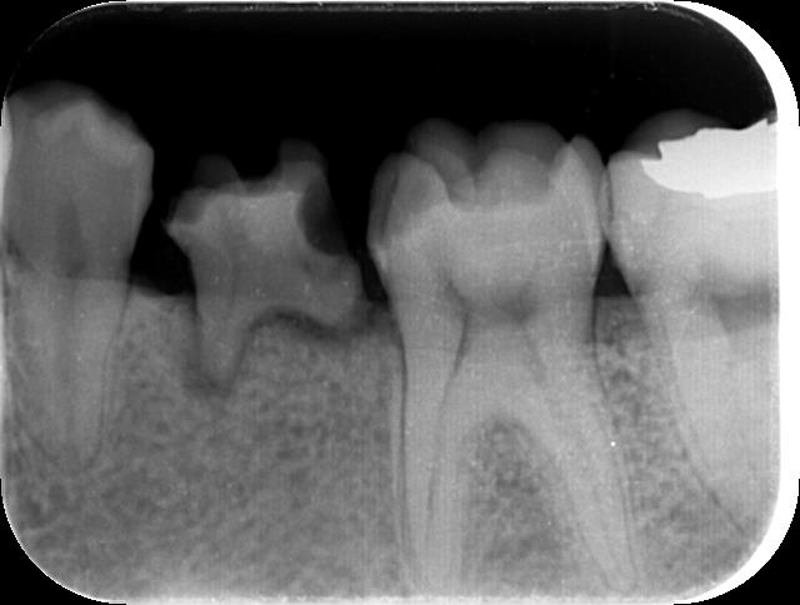 インプラントを行う予定の抜歯前のレントゲン写真