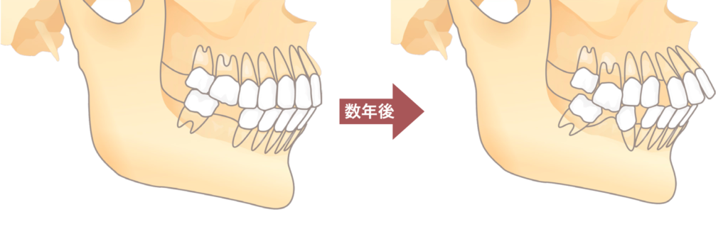 歯が抜けたまま放置するとこのように他の歯が動き，必要な治療が増えてしまいます．