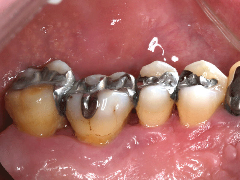 歯周病により揺れている歯