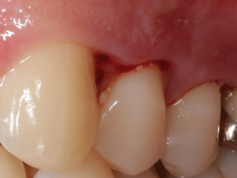 炎症により歯肉からの出血が見られる状態