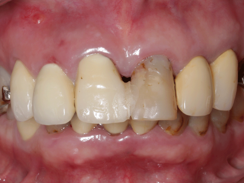歯の着色や変色が生じた状態