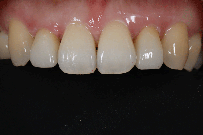 セラミックで修復した自然な歯