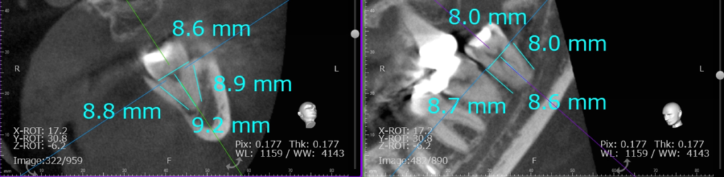 必要時はCT撮影を行い，移植のドナー歯の長さ，太さ，神経までの距離などを測定します．