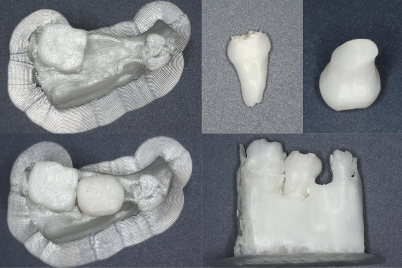 ３Dプリンタで製作した移植歯のレプリカは移植手術や術前のシュミレーションに用います．