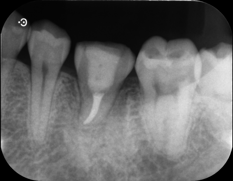 4ヶ月程度でレントゲンを撮ると骨ができている様子が確認できます．