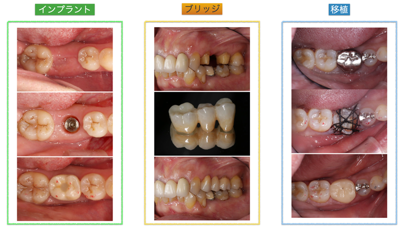 歯を抜いた後の治療の選択肢については，それぞれのメリットデメリットをしっかり説明して相談いたします．