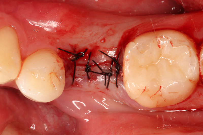 インプラントの１次手術が終了した状態です．