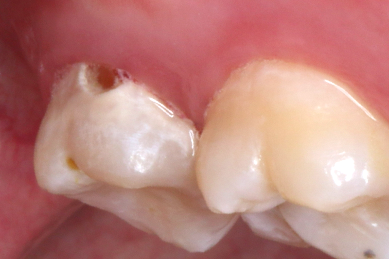脱灰からむし歯が進行すると穴が空いてしまいます．ANAは自然には塞がらないため，治療して平らな状態に埋めることが必要です．