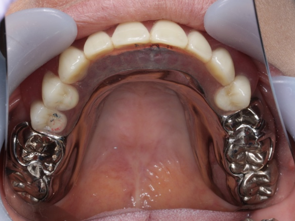 金属床義歯の写真です．薄く，いぶつ感が少なく，さらに安定しているためよく噛めます．