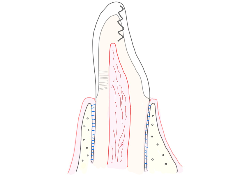 力がかかりすぎると歯がひび割れてしまうことがあり，しみる症状が生じる場合があります．クラックが神経まで達してしまう場合は歯内療法が必要となる場合もあります．