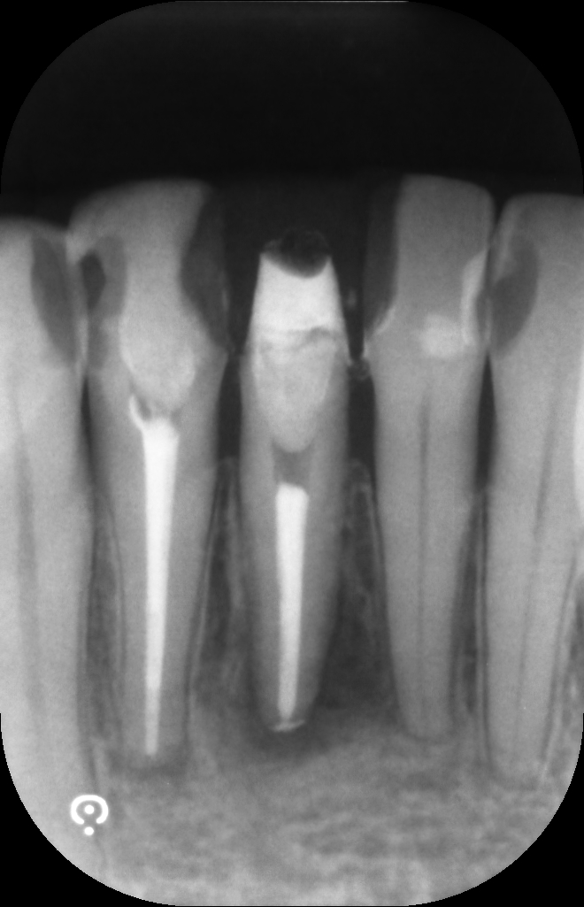 根管充填直後の写真です。根尖まで緊密な充填が確認できます。