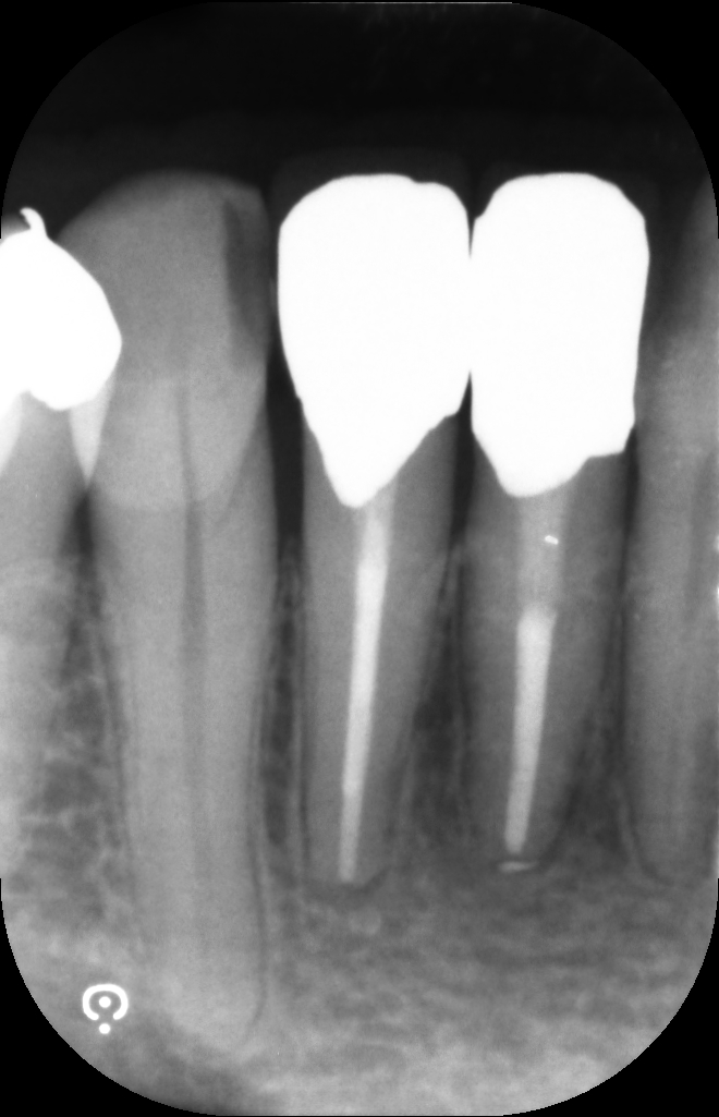 １年後の写真です。根尖部の黒い影は消え、骨ができていることが確認できます。